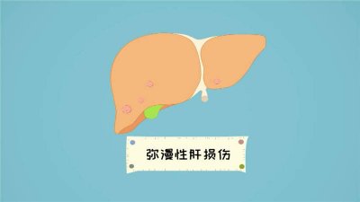 ​肝为什么会硬化 肝为什么会硬化腹水